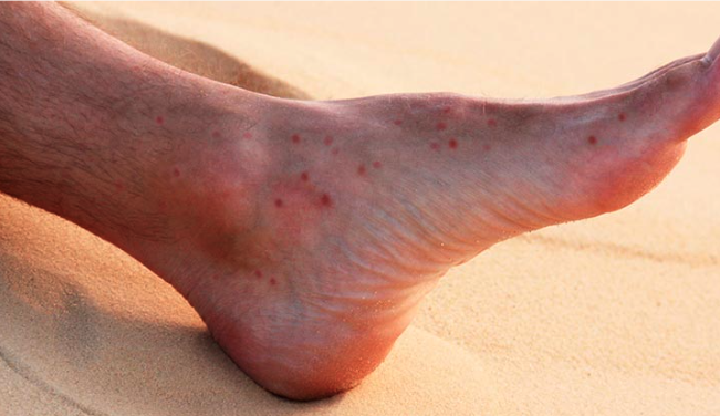 Yakarca ısırığı alerjisi yazısı için görsel. yakarca ısırığı küme belirtilerini gösterir.