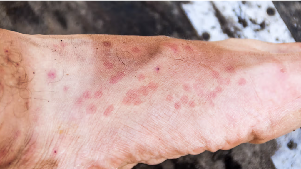 yakarca isirigi su toplamasi alerji